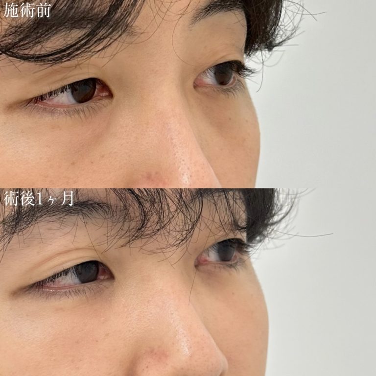 切らない目の下のクマ取り・目の下のたるみ（ふくらみ）取り(担当医:奥村 瞬 医師)の症例写真2