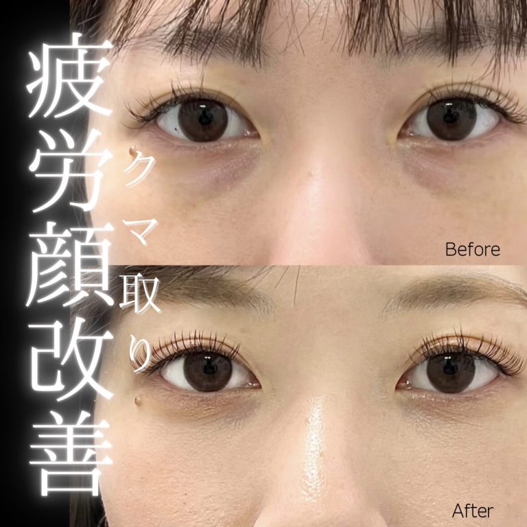 切らない目の下のクマ取り・目の下のたるみ（ふくらみ）取り(担当医:川島 康弘 医師)の症例写真1