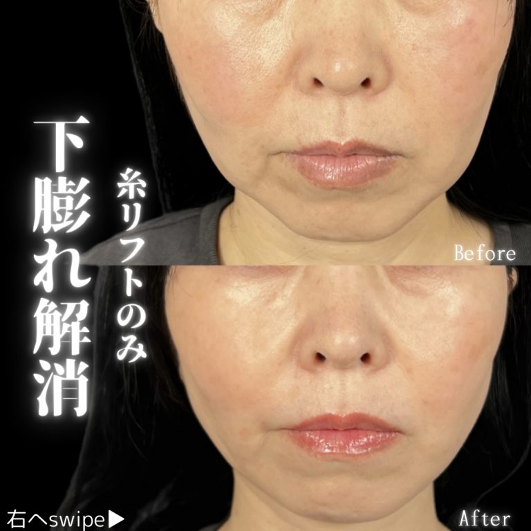 小顔美肌再生（リフトアップ）(担当医:川島 康弘 医師)の症例写真1
