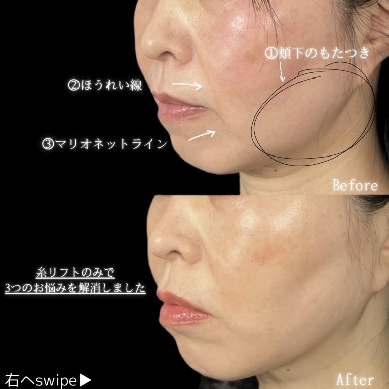 小顔美肌再生（リフトアップ）(担当医:川島 康弘 医師)の症例写真2