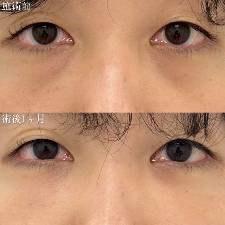 切らない目の下のクマ取り・目の下のたるみ（ふくらみ）取り(担当医:奥村 瞬 医師)の症例写真1