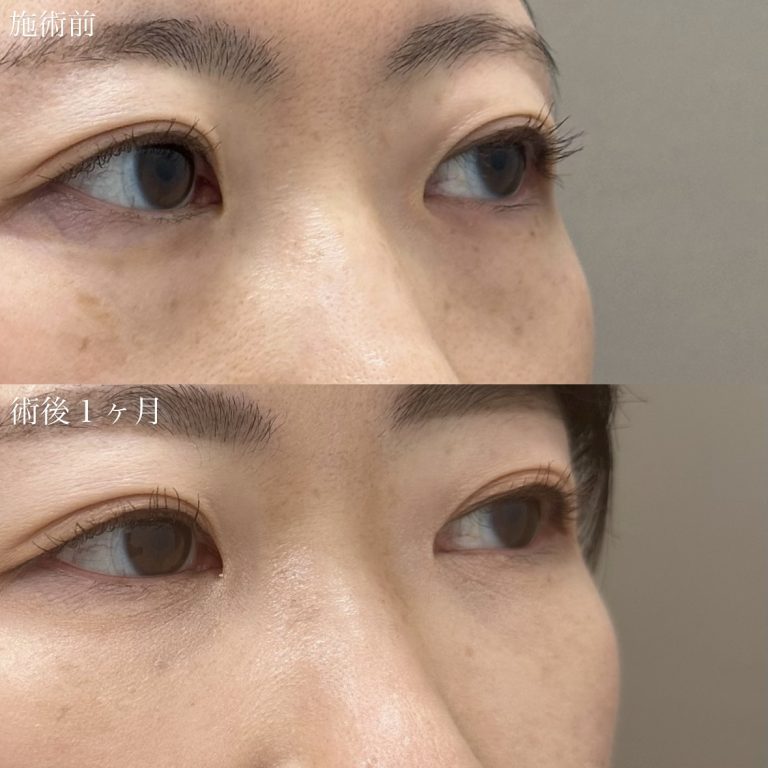 切らない目の下のクマ取り・目の下のたるみ（ふくらみ）取り(担当医:奥村 瞬 医師)の症例写真2