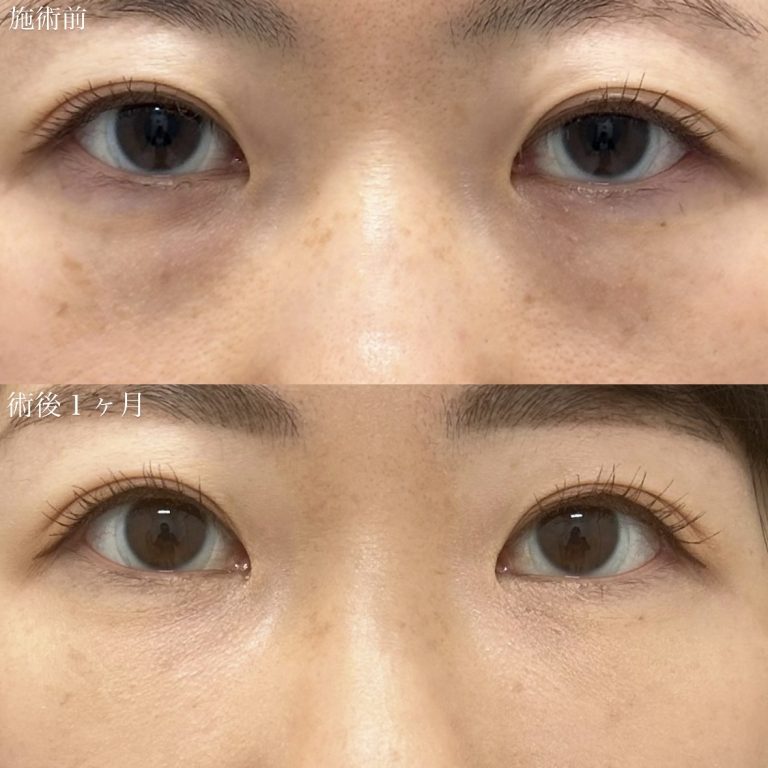 切らない目の下のクマ取り・目の下のたるみ（ふくらみ）取り(担当医:奥村 瞬 医師)の症例写真1