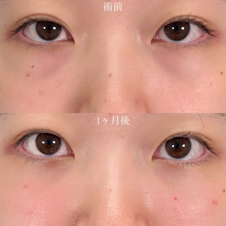 切らない目の下のクマ取り・目の下のたるみ（ふくらみ）取り(担当医:山口 征大 医師)の症例写真1
