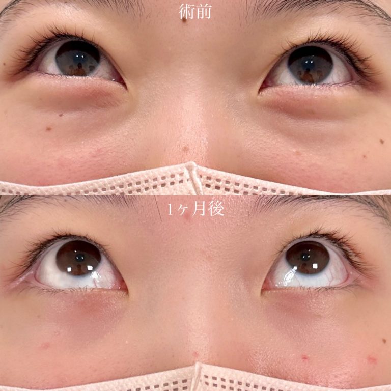 切らない目の下のクマ取り・目の下のたるみ（ふくらみ）取り(担当医:山口 征大 医師)の症例写真2