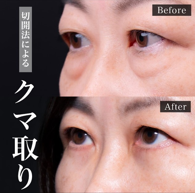 切開法による目の下のたるみ取り（下眼瞼除皺術）(担当医:岡本 卓也 医師)の症例写真2