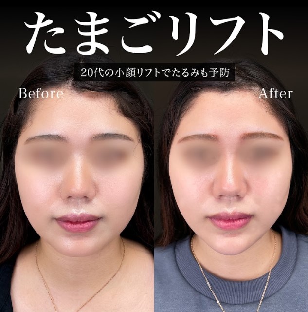 TCB小顔リフト(担当医:岡本 卓也 医師)の症例写真1