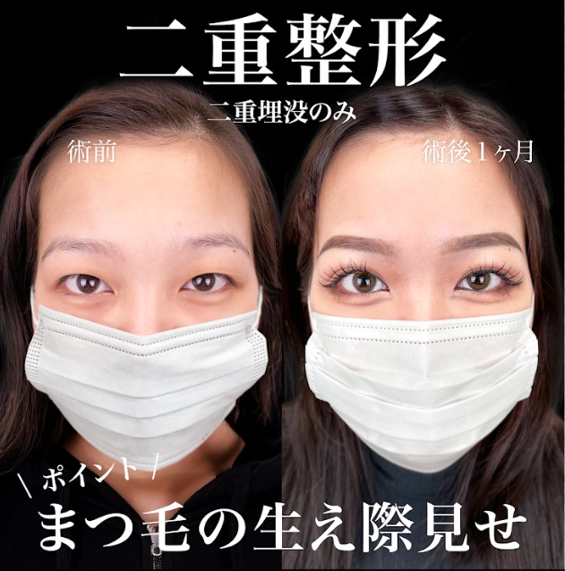 二重埋没法(担当医:岡本 卓也 医師)の症例写真1
