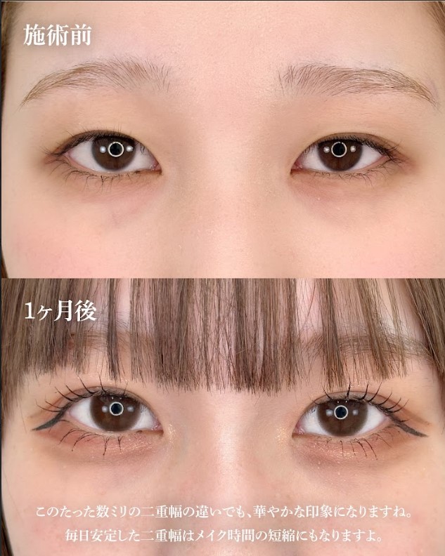 まぶたの脂肪取り(担当医:岡本 卓也 医師)の症例写真1