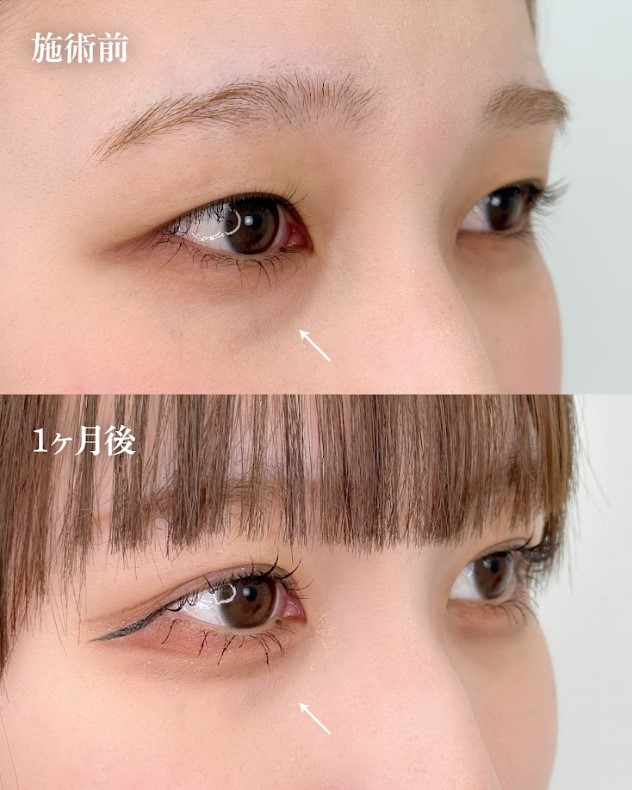 まぶたの脂肪取り(担当医:岡本 卓也 医師)の症例写真2