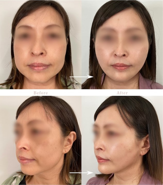 顔の脂肪吸引(担当医:岡本 卓也 医師)の症例写真1