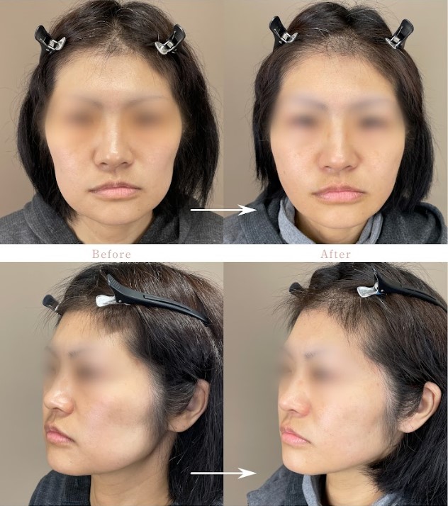 TCB小顔リフト(担当医:岡本 卓也 医師)の症例写真1