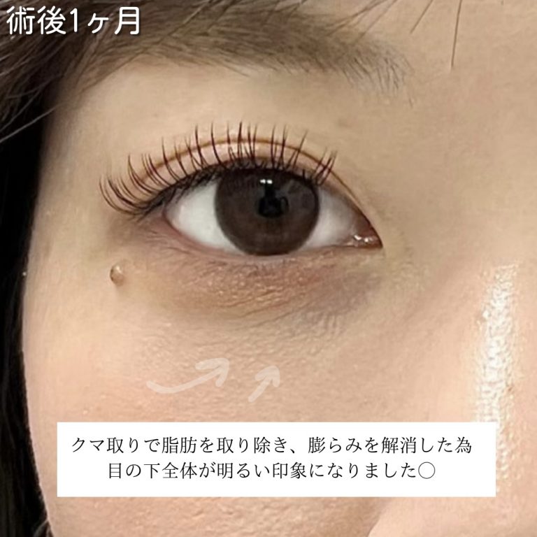 切らない目の下のクマ取り・目の下のたるみ（ふくらみ）取り(担当医:川島 康弘 医師)の症例写真3