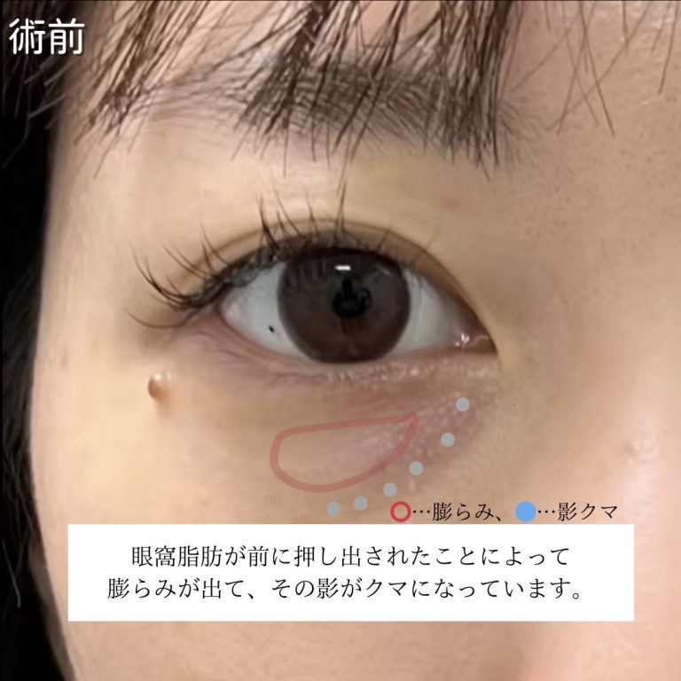 切らない目の下のクマ取り・目の下のたるみ（ふくらみ）取り(担当医:川島 康弘 医師)の症例写真2