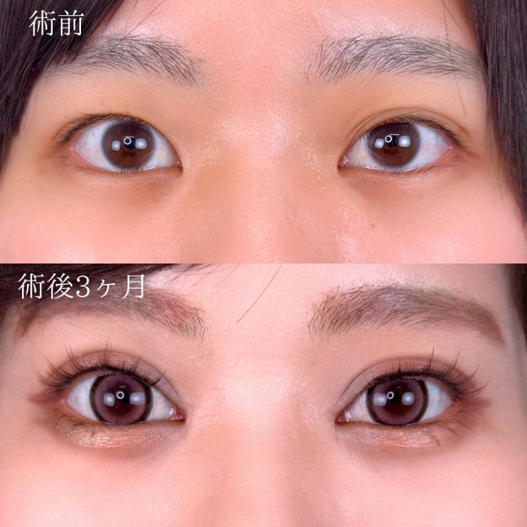 二重埋没法(担当医:奥田 真吾 医師)の症例写真1