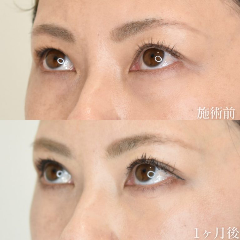 切らない目の下のクマ取り・目の下のたるみ（ふくらみ）取り(担当医:垣花 瑠美子 医師)の症例写真2