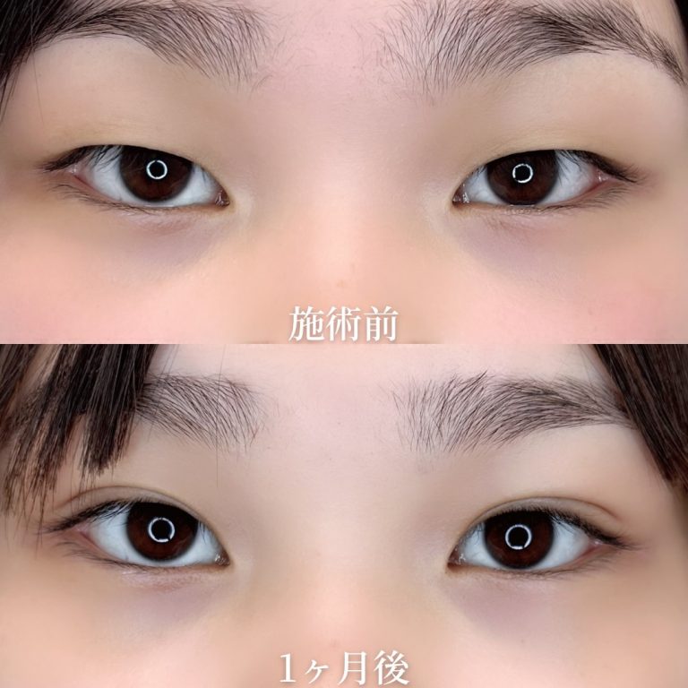 二重埋没法(担当医:垣花 瑠美子 医師)の症例写真1
