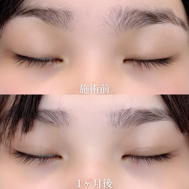二重埋没法(担当医:垣花 瑠美子 医師)の症例写真2