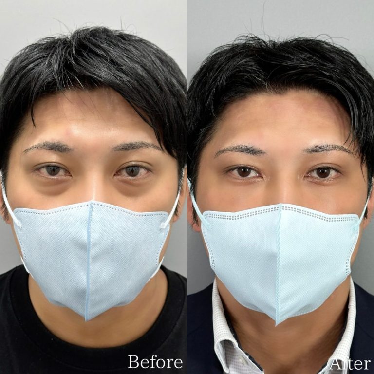切らない目の下のクマ取り・目の下のたるみ（ふくらみ）取り(担当医:佐野 孝治 医師)の症例写真1