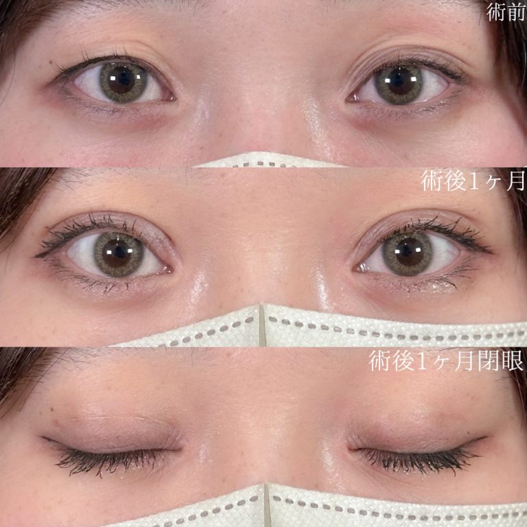 二重埋没法(担当医:佐野 孝治 医師)の症例写真1