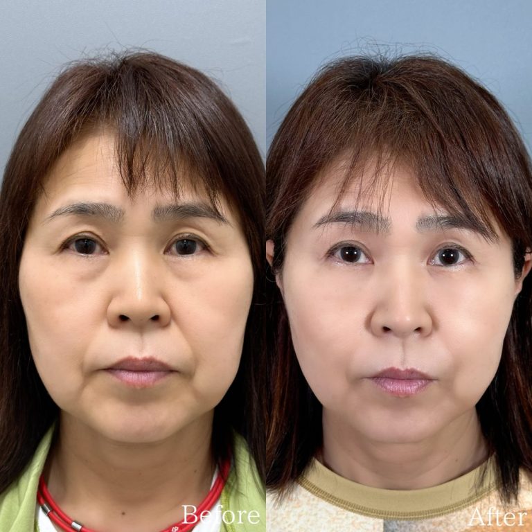 切らない目の下のクマ取り・目の下のたるみ（ふくらみ）取り(担当医:佐野 孝治 医師)の症例写真1