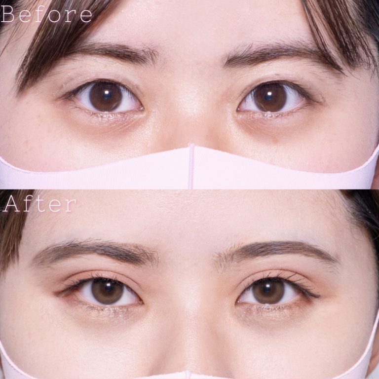 二重埋没法(担当医:TCB 医師)の症例写真1