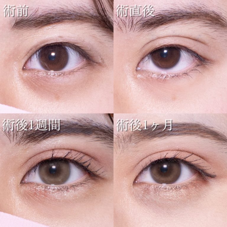 二重埋没法(担当医:TCB 医師)の症例写真2