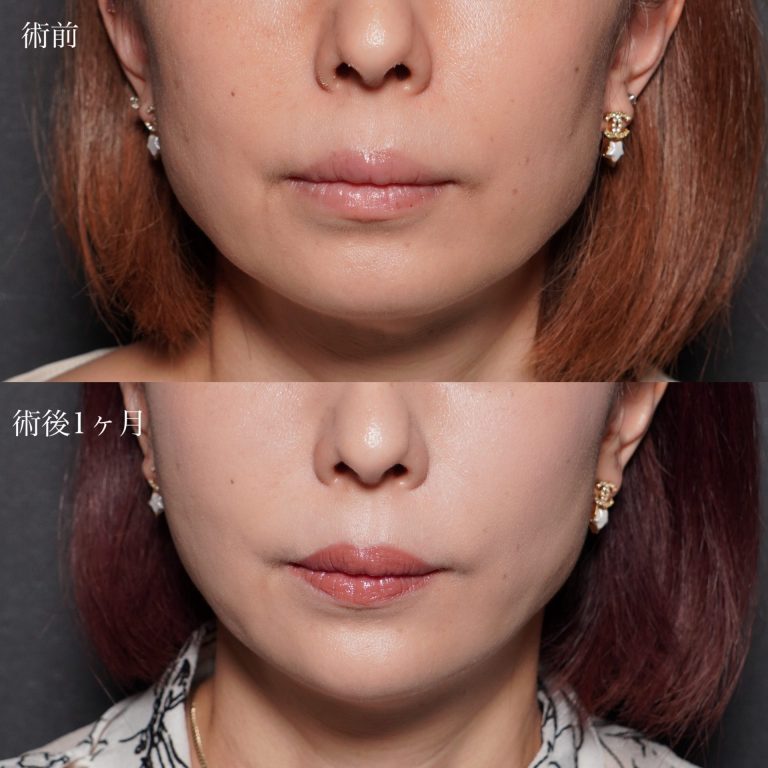 顔の脂肪吸引(担当医:北村 可恋 医師)の症例写真1