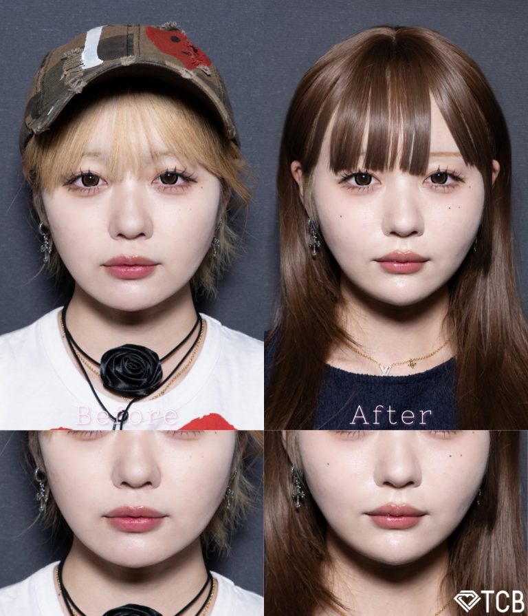 小顔美肌再生（リフトアップ）(担当医:北村 可恋 医師)の症例写真1