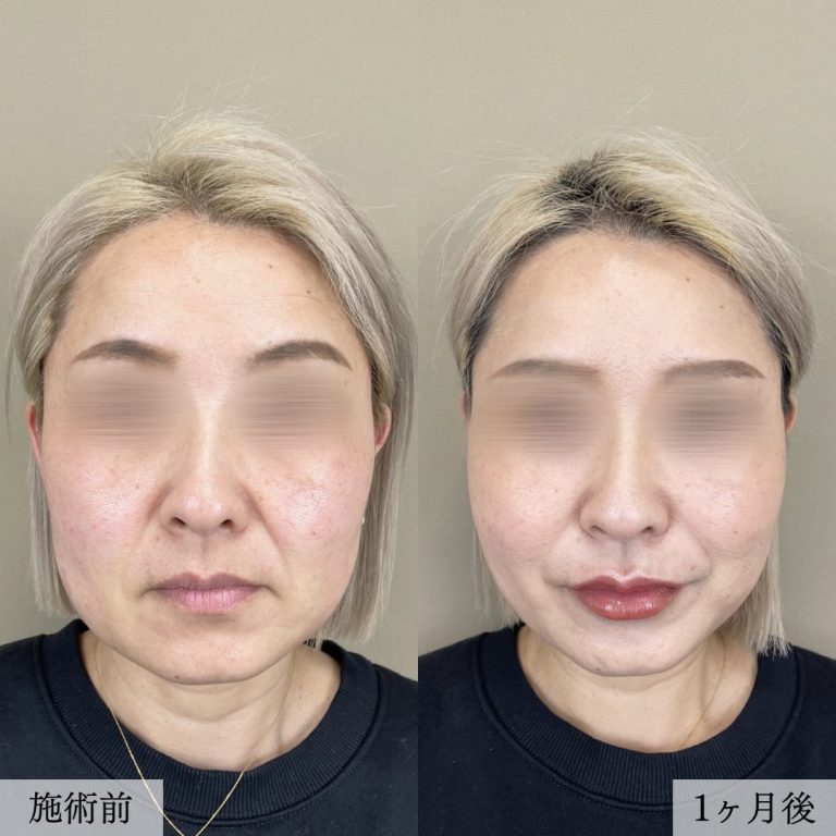 小顔美肌再生（リフトアップ）(担当医:大見 貴秀 医師)の症例写真1