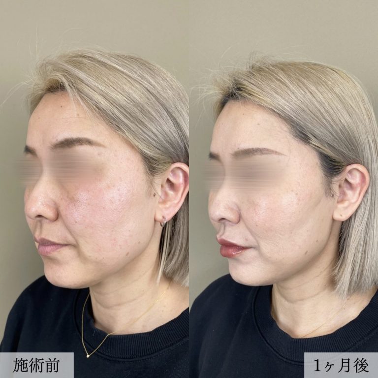 小顔美肌再生（リフトアップ）(担当医:大見 貴秀 医師)の症例写真2