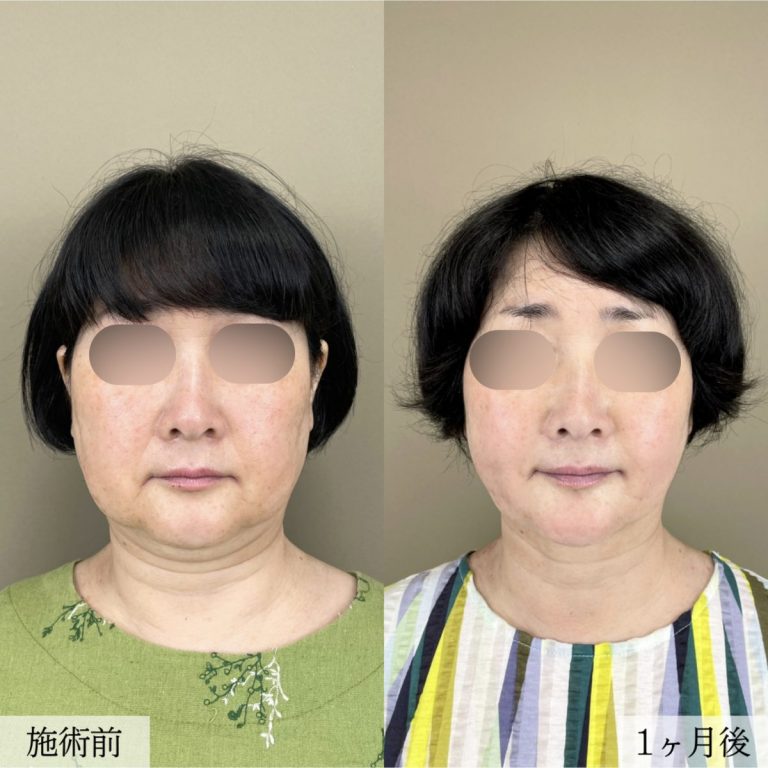 顔の脂肪吸引(担当医:大見 貴秀 医師)の症例写真1