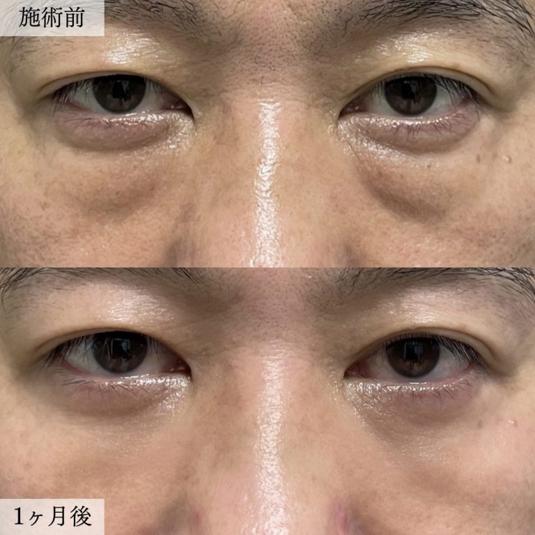 切らない目の下のクマ取り・目の下のたるみ（ふくらみ）取り(担当医:大見 貴秀 医師)の症例写真1