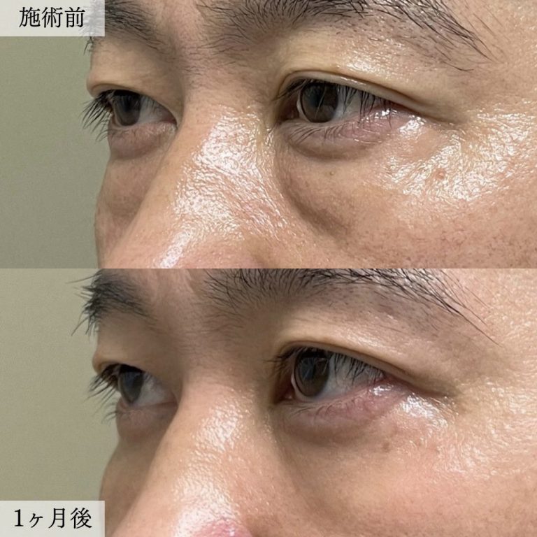 切らない目の下のクマ取り・目の下のたるみ（ふくらみ）取り(担当医:大見 貴秀 医師)の症例写真2