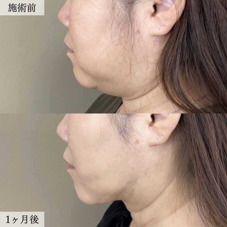 顔の脂肪吸引(担当医:大見 貴秀 医師)の症例写真1