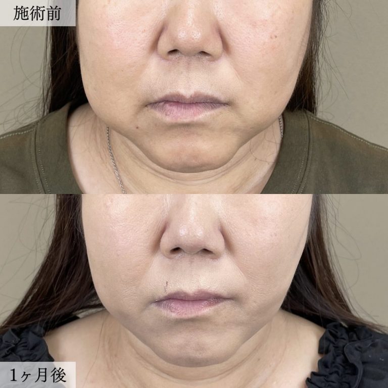 顔の脂肪吸引(担当医:大見 貴秀 医師)の症例写真2