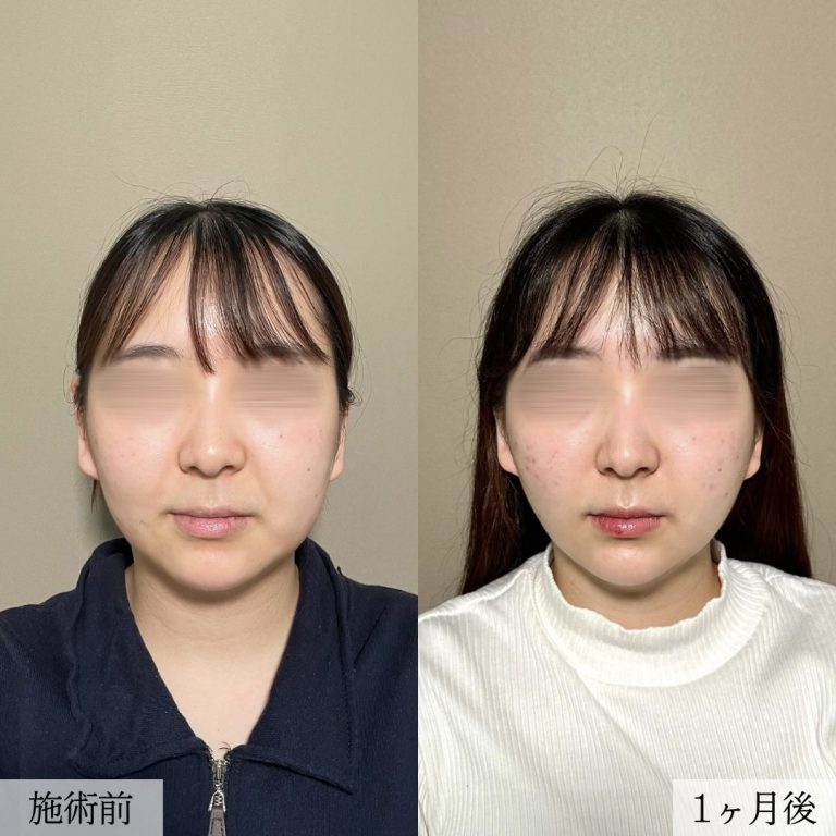 小顔美肌再生（リフトアップ）(担当医:大見 貴秀 医師)の症例写真1