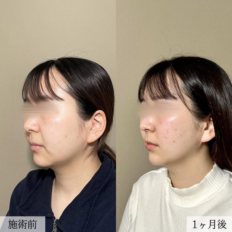 小顔美肌再生（リフトアップ）(担当医:大見 貴秀 医師)の症例写真2
