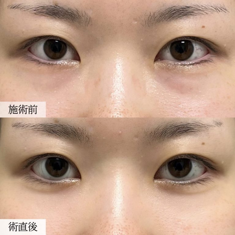 切らない目の下のクマ取り・目の下のたるみ（ふくらみ）取り(担当医:大見 貴秀 医師)の症例写真1