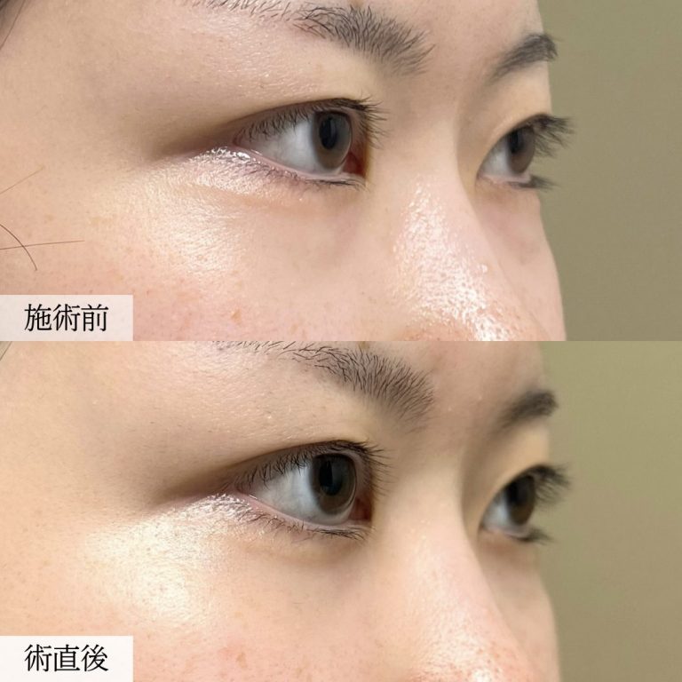 切らない目の下のクマ取り・目の下のたるみ（ふくらみ）取り(担当医:大見 貴秀 医師)の症例写真2