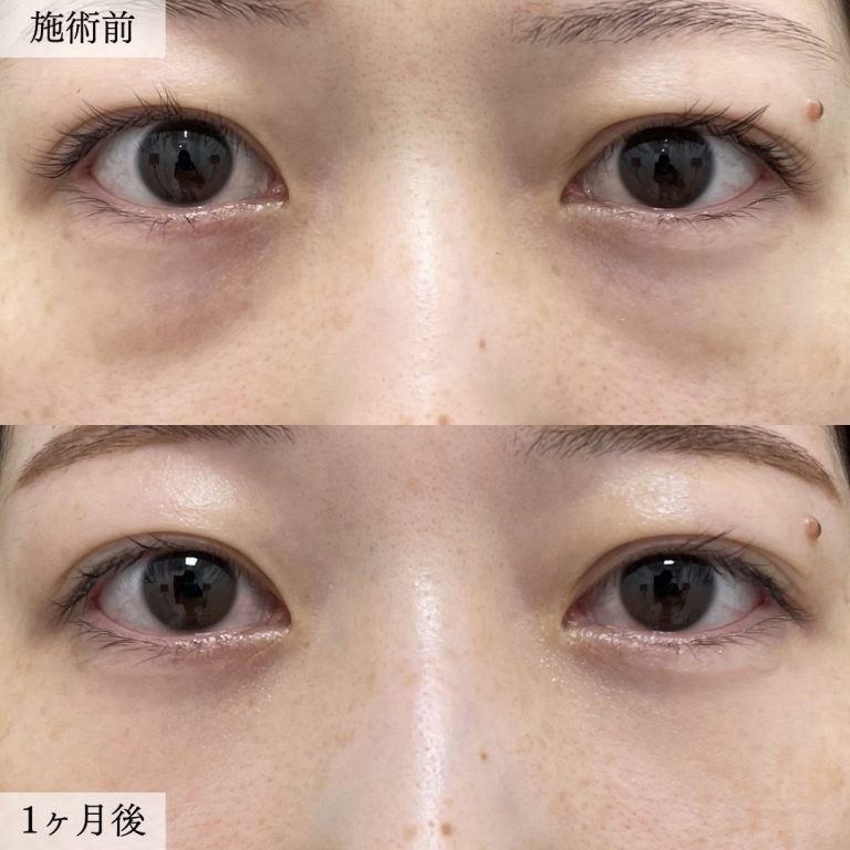 切らない目の下のクマ取り・目の下のたるみ（ふくらみ）取り(担当医:大見 貴秀 医師)の症例写真1