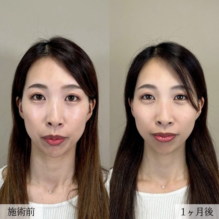 小顔美肌再生（リフトアップ）(担当医:大見 貴秀 医師)の症例写真1