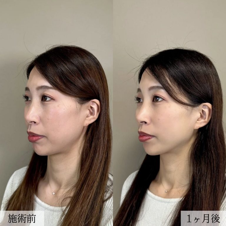 小顔美肌再生（リフトアップ）(担当医:大見 貴秀 医師)の症例写真2