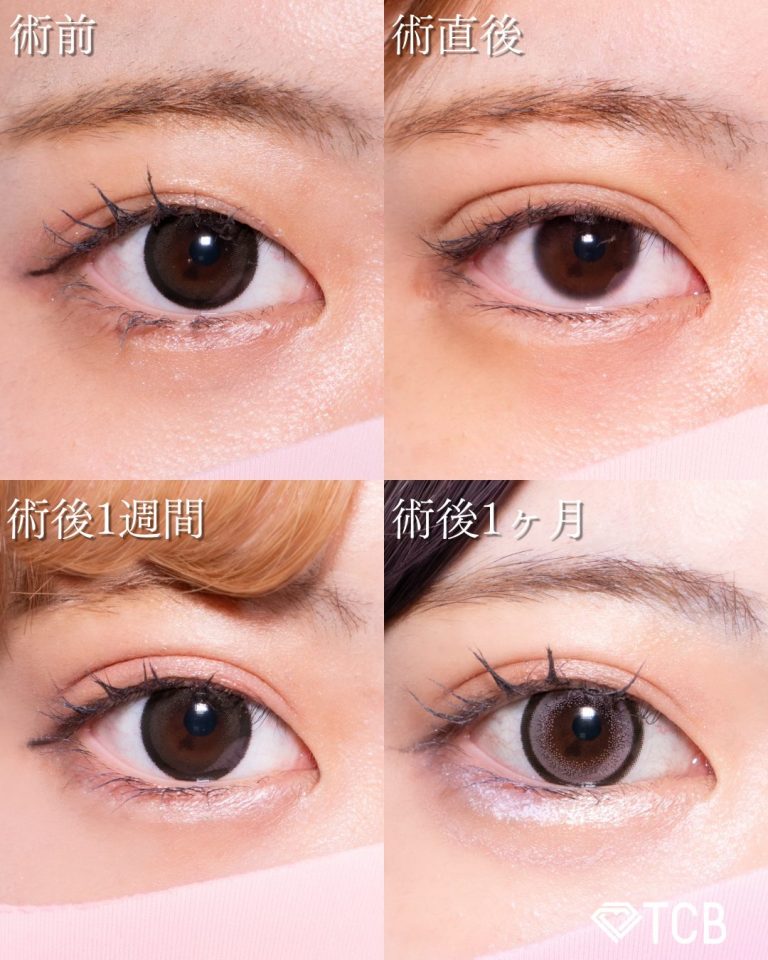 二重埋没法(担当医:北村 可恋 医師)の症例写真2