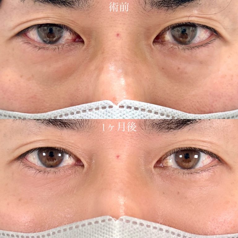 切らない目の下のクマ取り・目の下のたるみ（ふくらみ）取り(担当医:山口 征大 医師)の症例写真1