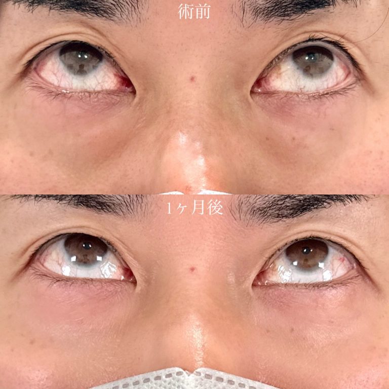 切らない目の下のクマ取り・目の下のたるみ（ふくらみ）取り(担当医:山口 征大 医師)の症例写真2