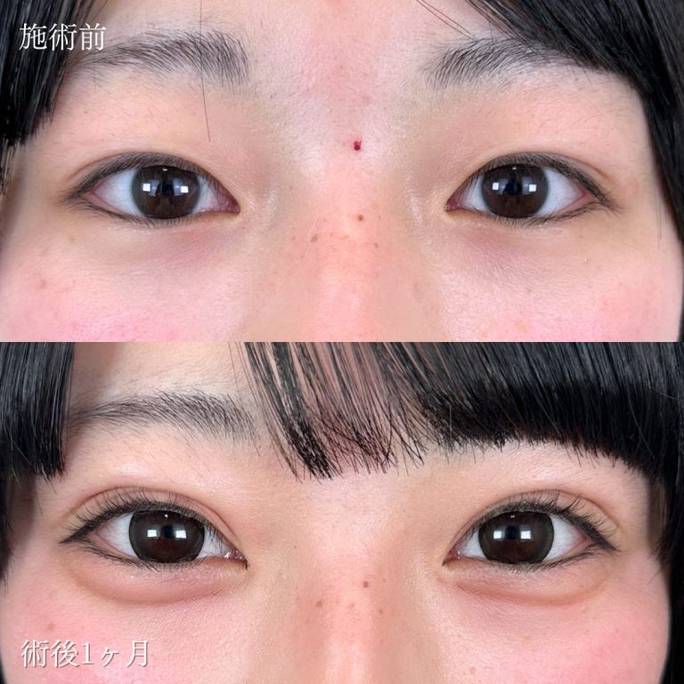 二重埋没法(担当医:向田 敦史 医師)の症例写真1