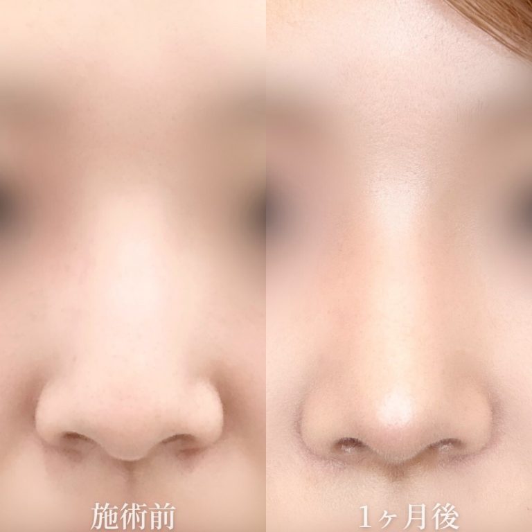 鼻尖形成(担当医:垣花 瑠美子 医師)の症例写真1