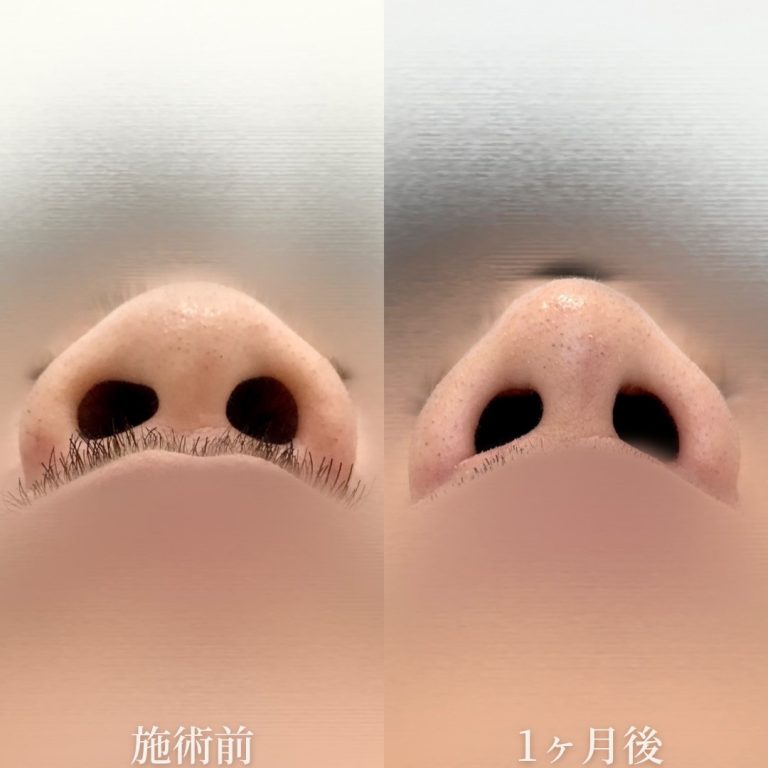 鼻尖形成(担当医:垣花 瑠美子 医師)の症例写真2