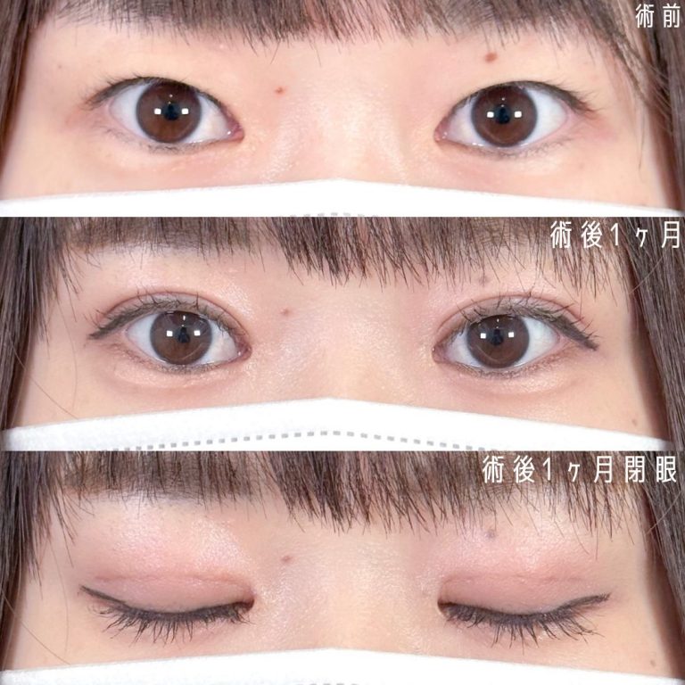 二重埋没法(担当医:佐野 孝治 医師)の症例写真1